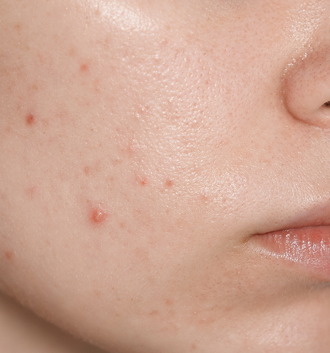 Acne behandelen gent art medico clinic