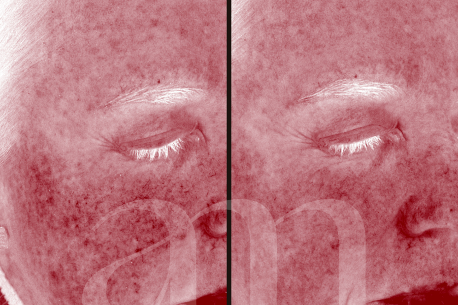 Couperose voor en na foto