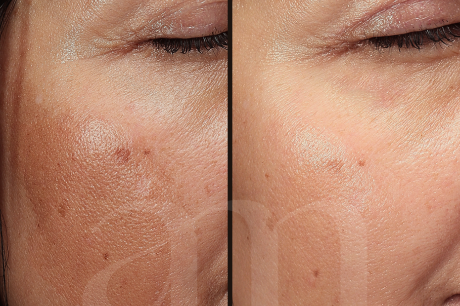 Pigment laserbehandeling voor en na foto