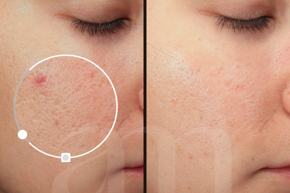 before after poriën laserbehandeling microneedling