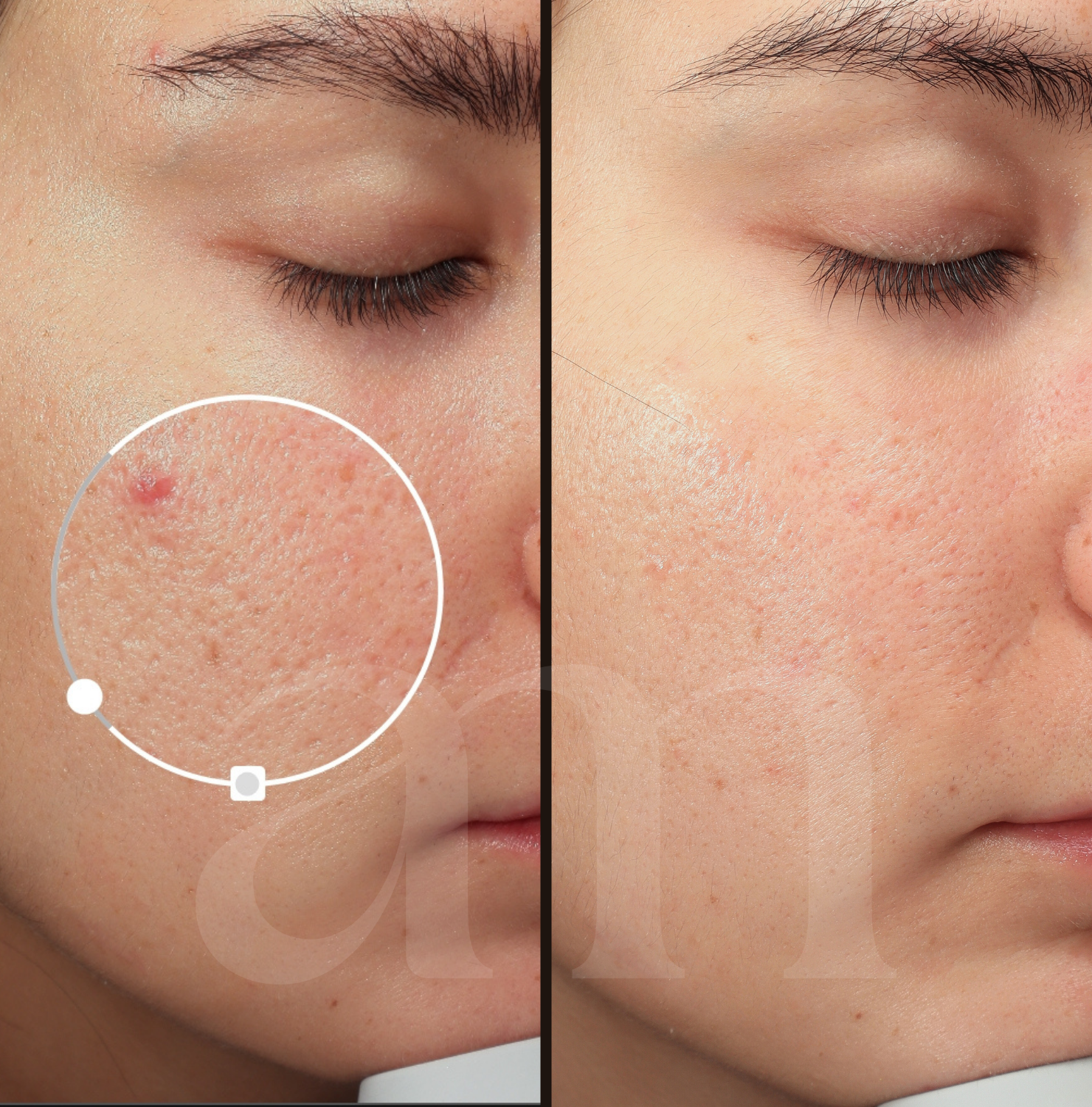 before after poriën laserbehandeling microneedling