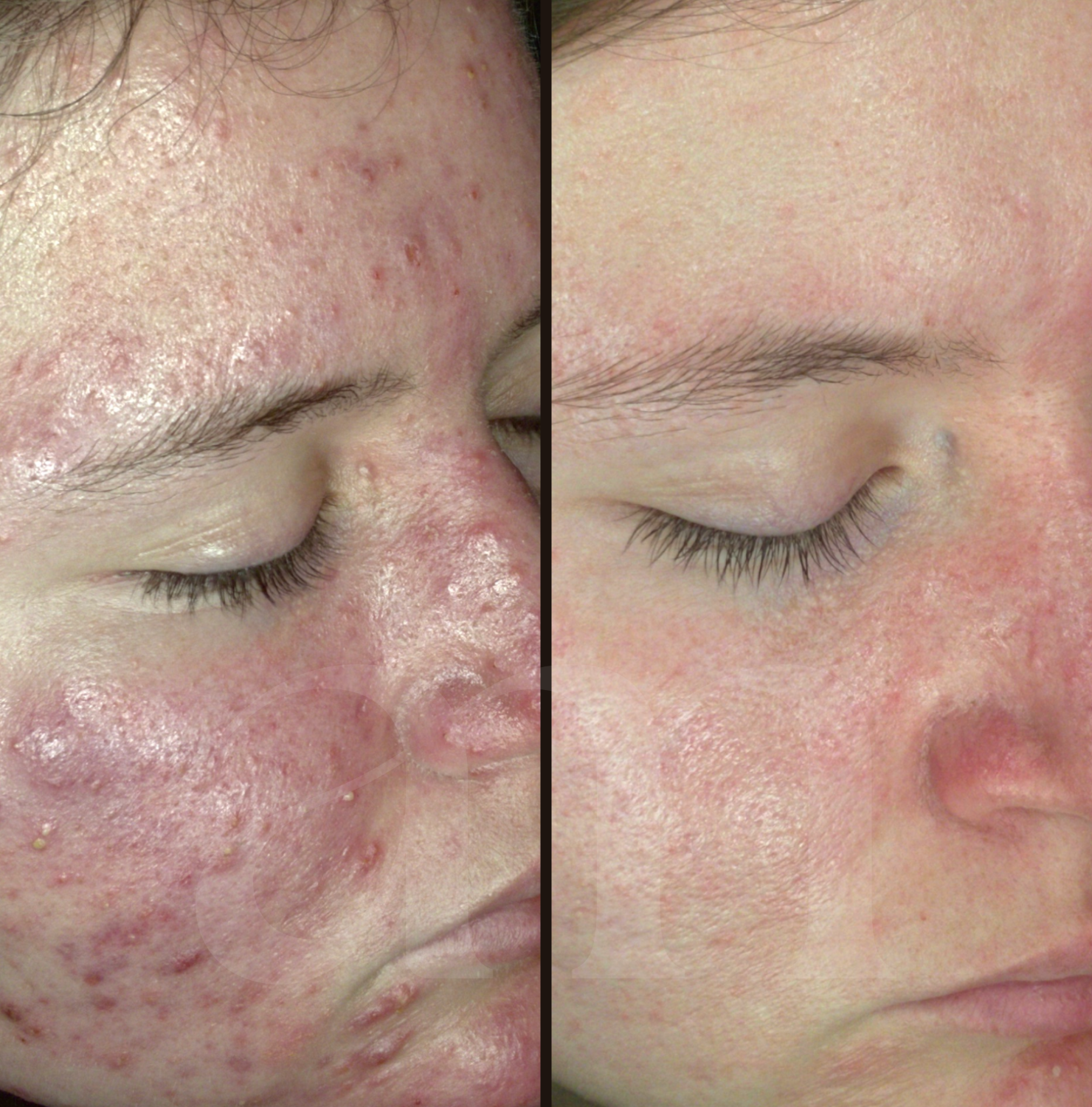 Hormonale acné before after