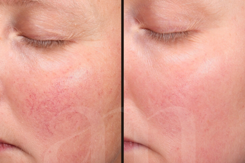 Adertjes roodheden couperose rosacea voor en na foto