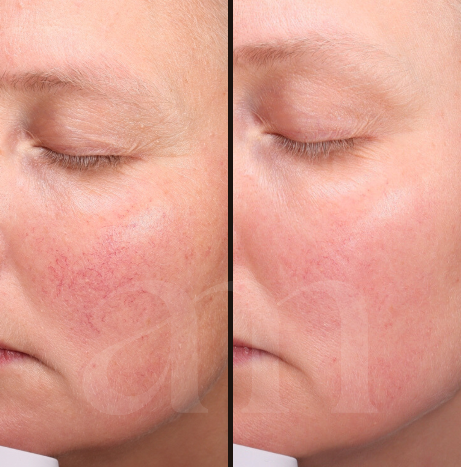Adertjes roodheden couperose rosacea voor en na foto