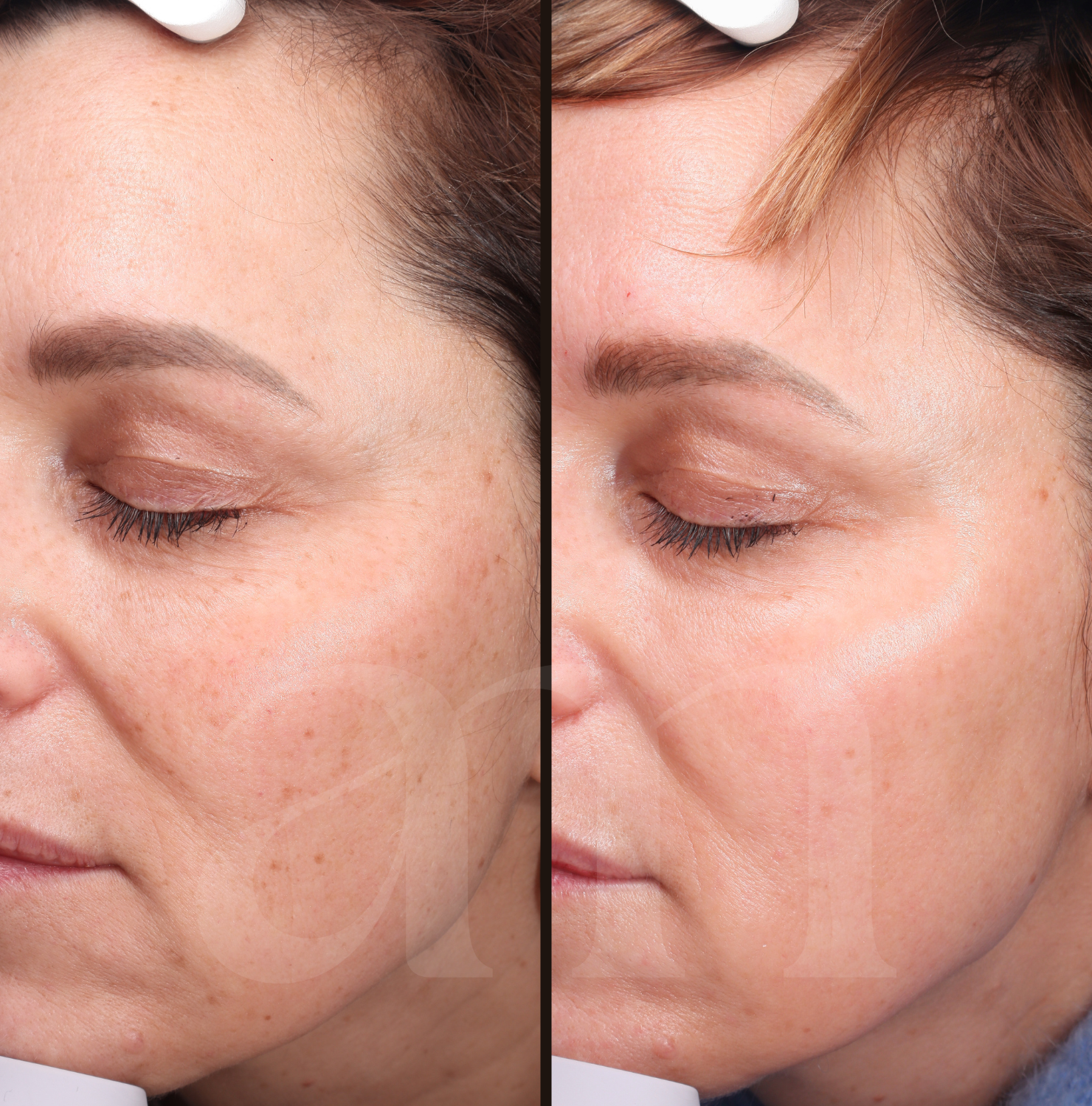 Huidverbetering huidverjonging microneedling glow
