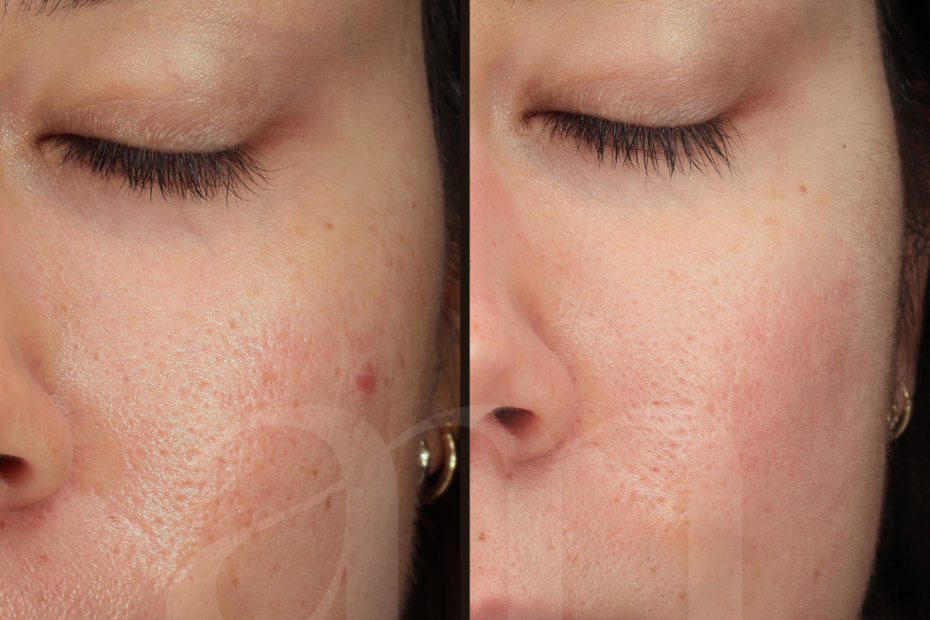 Porën before after laserbehandeling microneedling