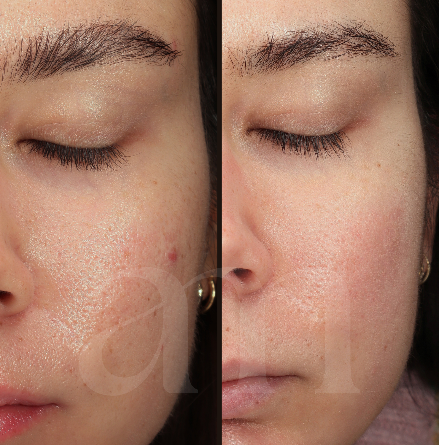 Porën before after laserbehandeling microneedling