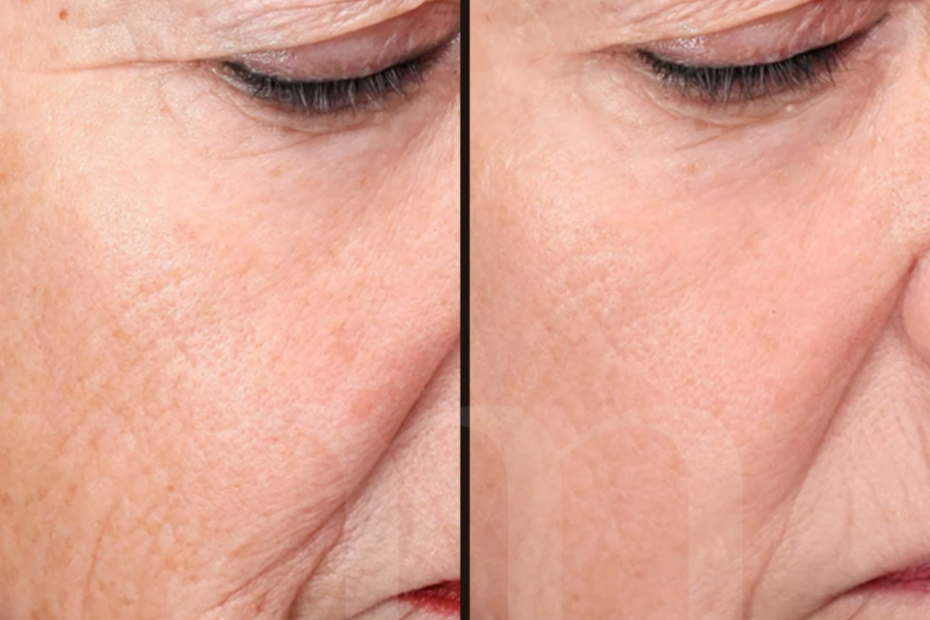 Huidverjonging before after laserbehandeling