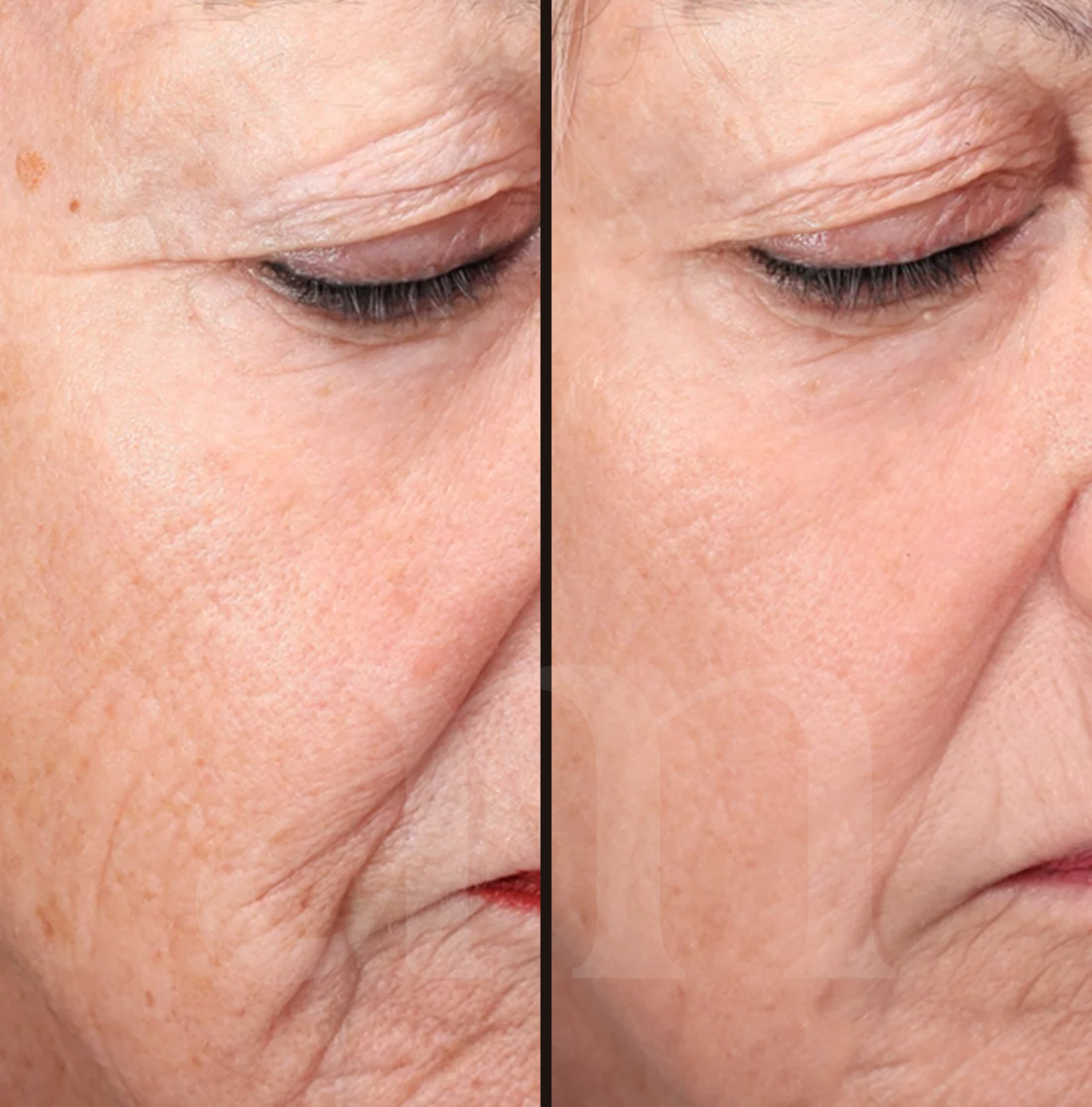 Huidverjonging before after laserbehandeling