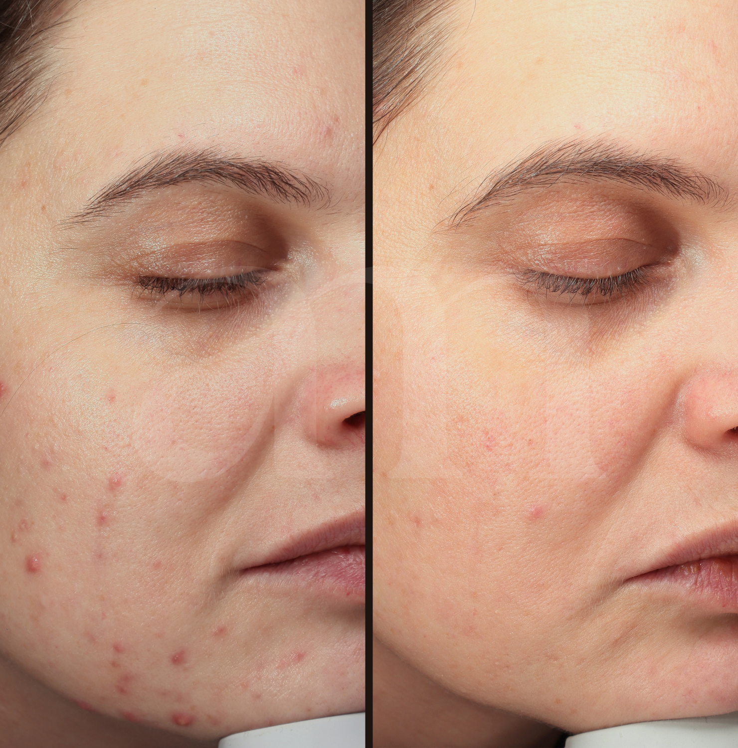 Hormonale acne voor en na foto medische peeling laserbehandeling