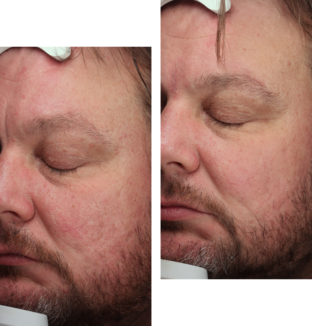 Huidverbetering man acné littekens couperose