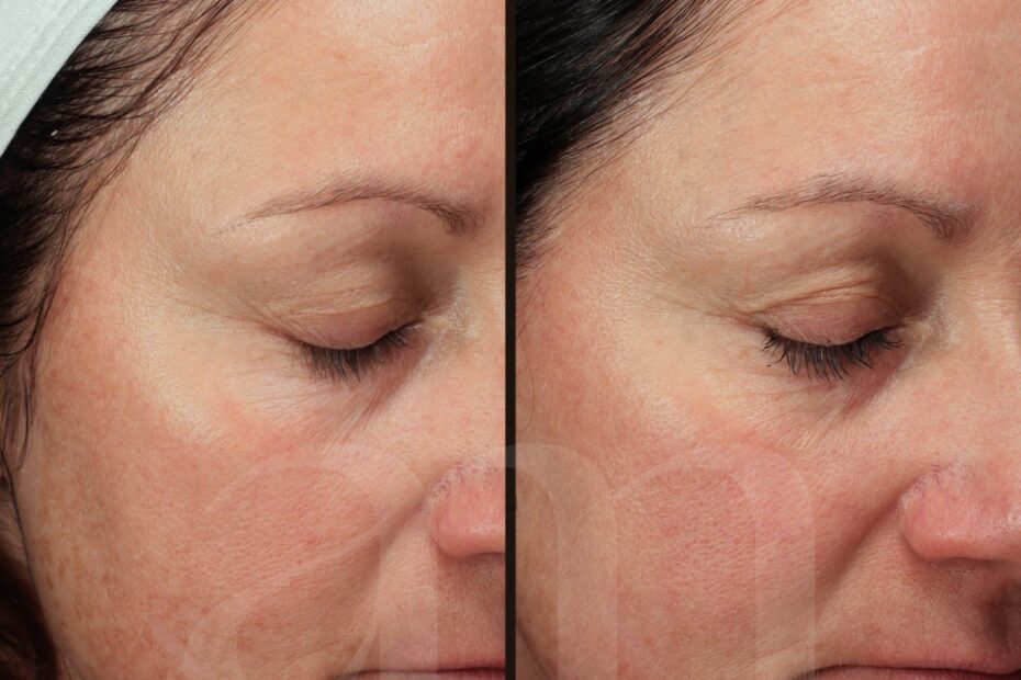 voor en na foto pigment, laserbehandeling, microneedling