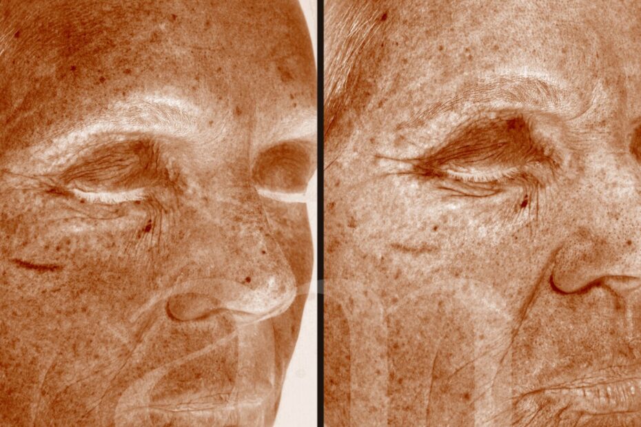 Voor en na foto vivace, Venezia lift en microneedling
