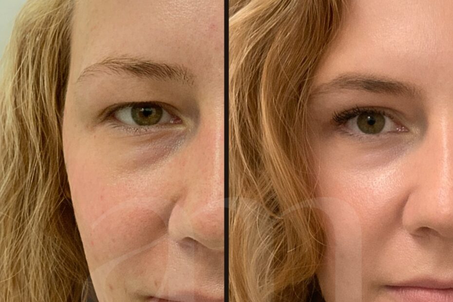 Ooglidcorrectie voor en na foto before after