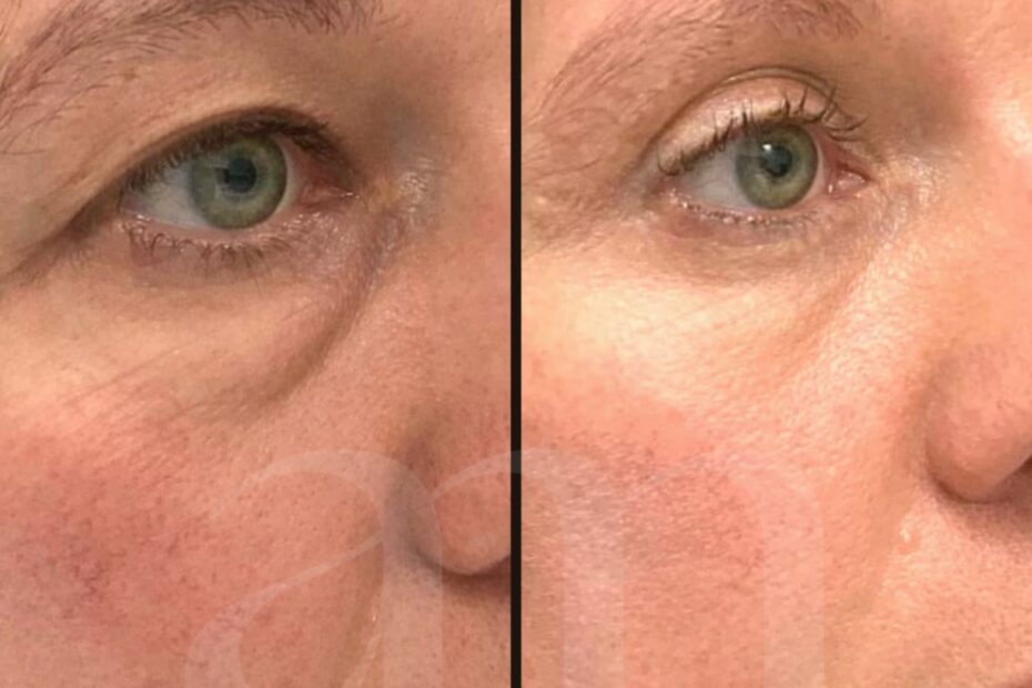 Ooglidcorrectie (7) – Art Medico Clinic