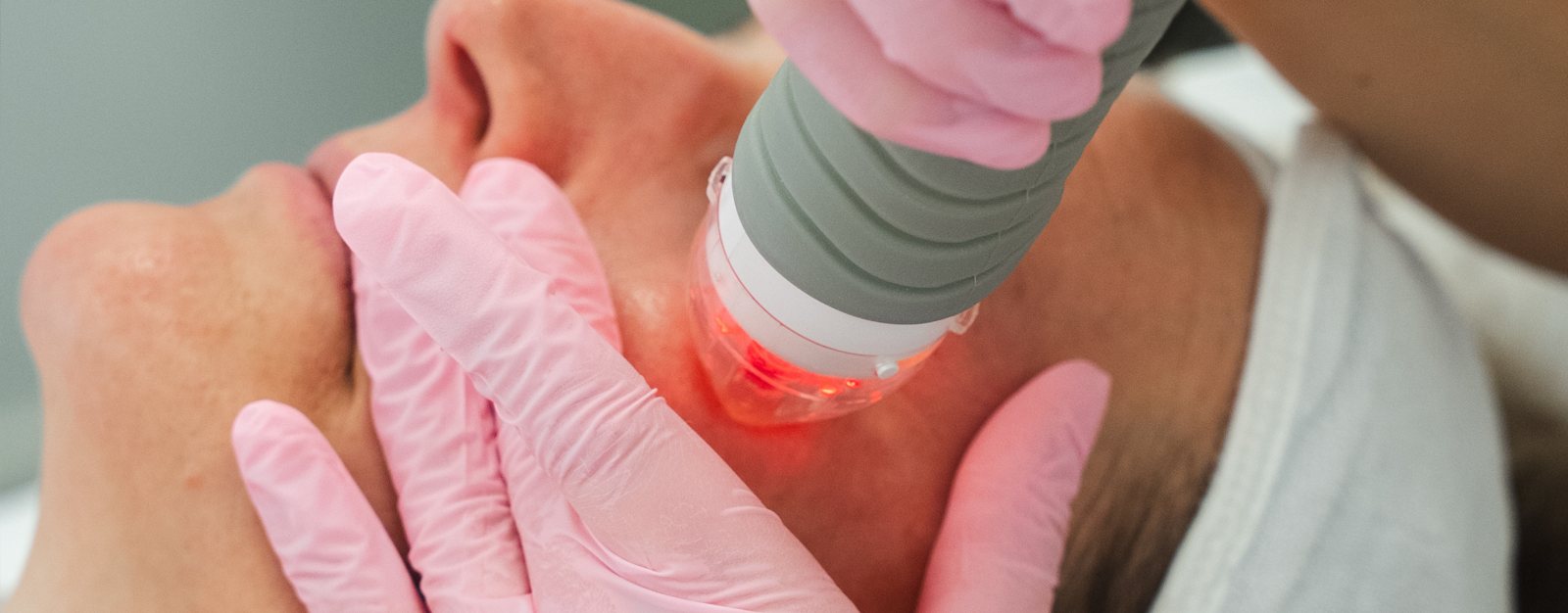 Vivace RF microneedling