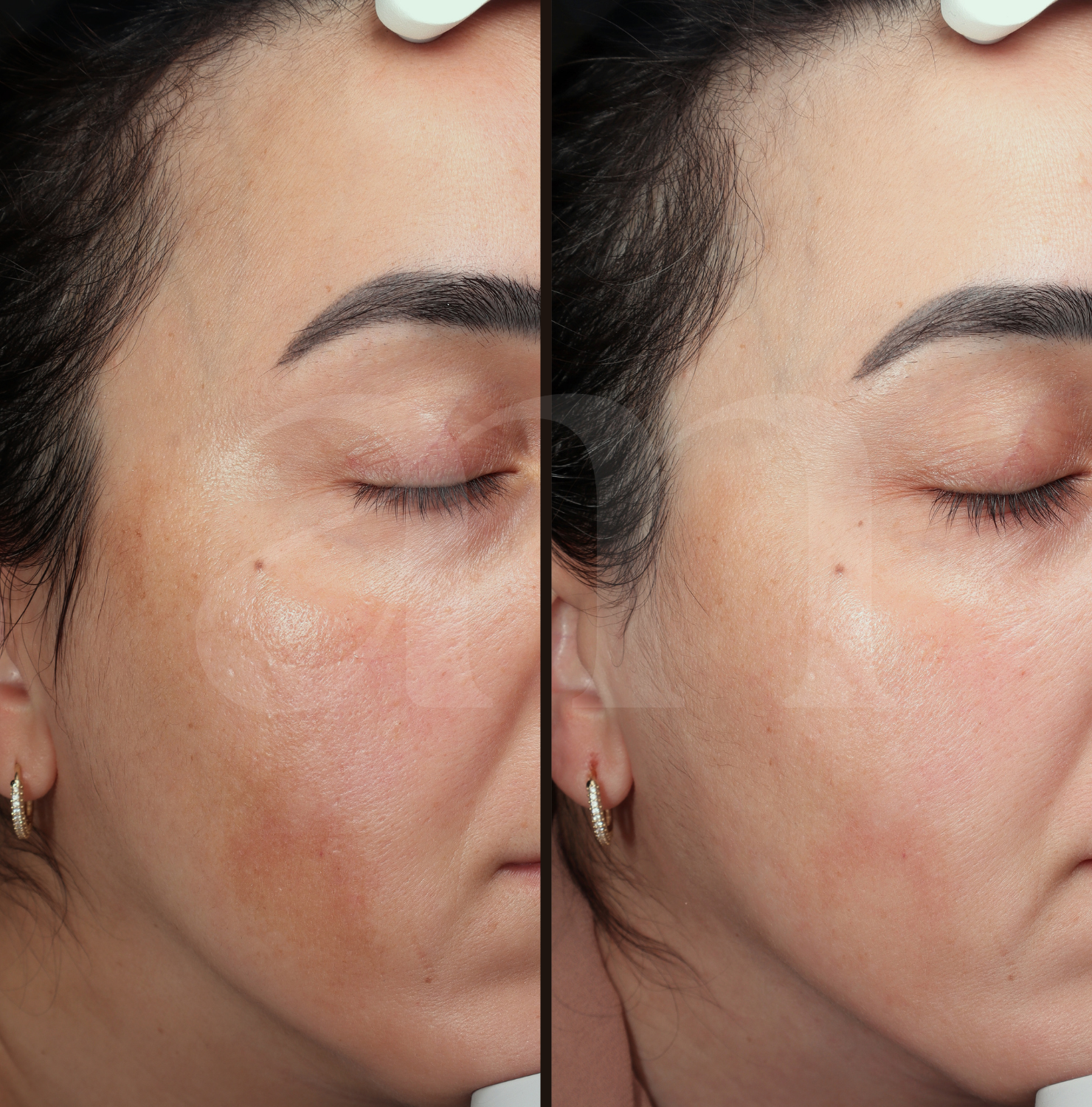 Pigment melasma aanpakken voor en na foto